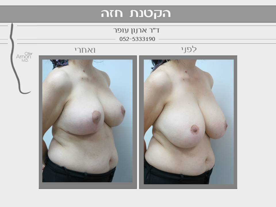 הקטנת חזה לפני ואחרי