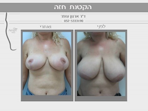 Read more about the article הקטנת חזה לבעלת חזה גדול ונפול